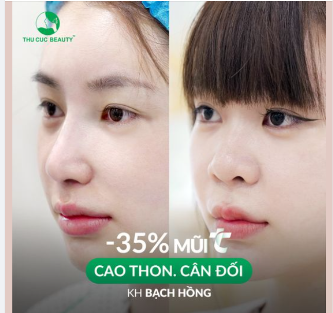 Giờ đây chị em không còn tự ti vì mũi thấp tẹt nữa