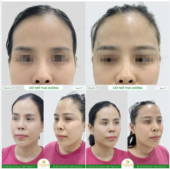 Những vùng lõm trên gương mặt có thể khiến mọi người trông già dặn, hốc hác và thiếu sức sống, và nếu lõm vùng thái dương cũng vậy.