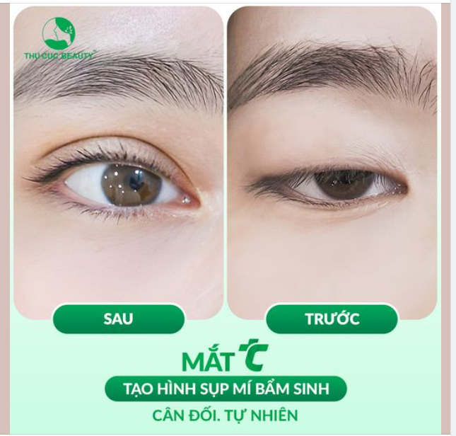 Sụp mí bẩm sinh - Khắc phục nhược điểm này chỉ với 1 lần DUY NHẤT – hiệu quả DÀI LÂU!