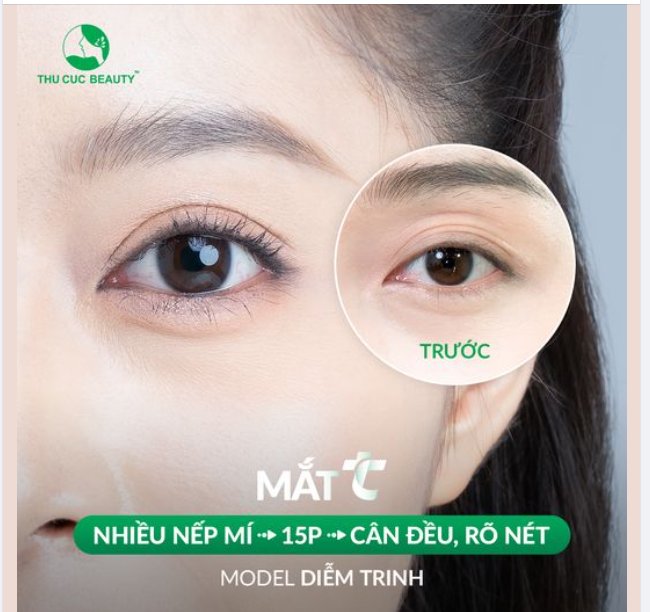 Bùng nổ ưu đãi cắt mí -40% chỉ còn duy nhất 1 ngày đăng ký