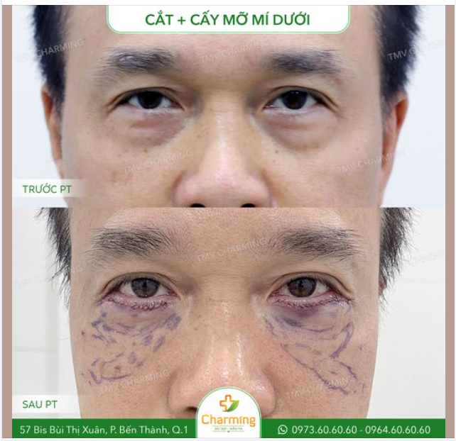 Chàng khách của Charming gặp phải tình trạng hốc mắt sâu nhưng phần mí dưới lại có da chùng nhiều, mí trên lại gặp vấn đề mí sụp, từ đó khiến tổng thể gương mặt chàng trông lờ đờ, già dặn hơn so với tuổi.