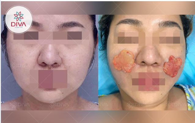 MẶT TRÒN, MÁ PHÍNH MỠ LÀM SAO KHẮC PHỤC?