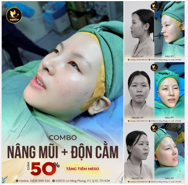 COMBO NÂNG MŨI + ĐỘN CẰM - ĐẸP TOÀN DIỆN CHỈ TRONG 1 LẦN