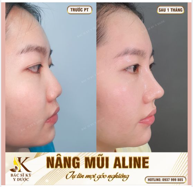 MŨI XINH CHO CÁC CHỊ EM ĐANG ĐAU ĐẦU VÌ DÁNG MŨI THẤP ĐÂY Ạ!!