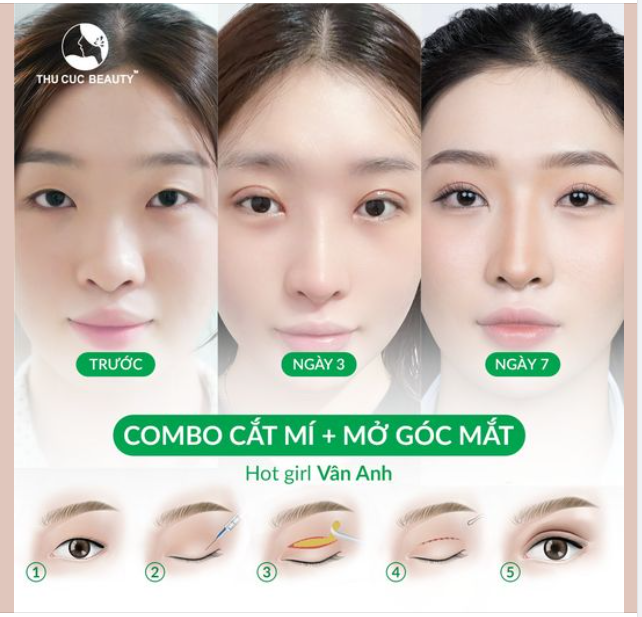 Hot girl Vân Anh chọn Mắt TC để sở hữu nếp mí to tròn, tự nhiên