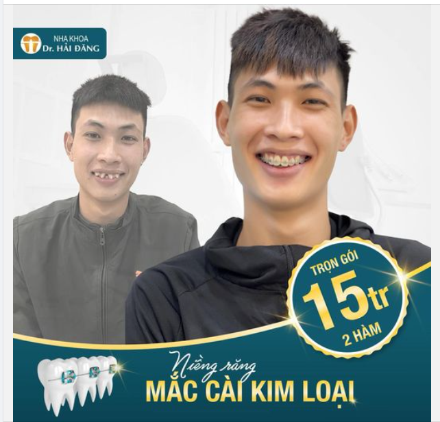 NIỀNG RĂNG SỚM CHO RĂNG ĐỀU ĐẸP