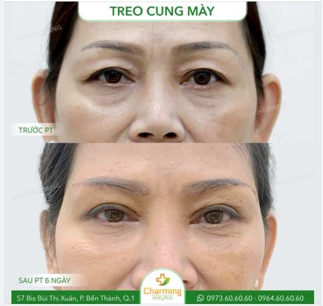 Khi càng dần tiến đến tuổi trung niên thì vùng mắt của chúng ta lại càng bị ảnh hưởng bởi quá trình lão hóa.