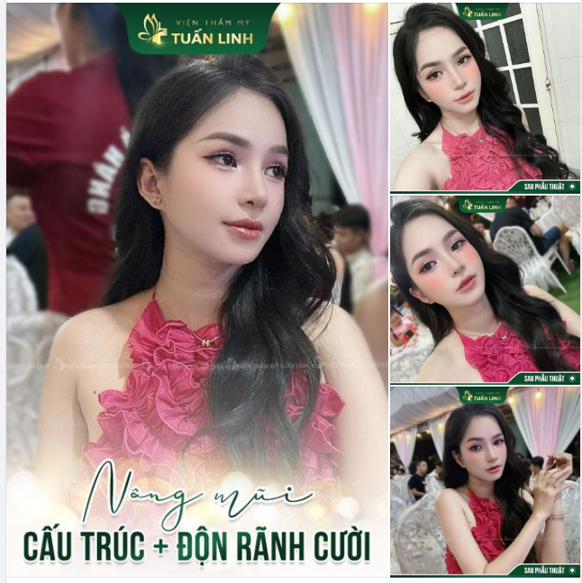Nâng mũi cấu trúc + Độn rãnh cười Bí quyết giúp trẻ hóa gương mặt.