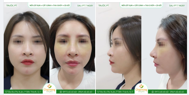 Dù nhìn góc nào thì cũng thấy được sự thay đổi tích cực trên gương mặt nàng khách sau khi đã nâng mũi lót sụn, cắt cánh mũi, thu chóp, cà gồ tại Charming.