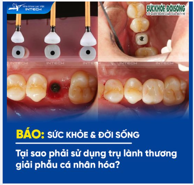 TẠI SAO PHẢI SỬ DỤNG TRỤ LÀNH THƯƠNG GIẢI PHẪU CÁ NHÂN HÓA VÀ GIẢI PHÁP CỦA LẠC VIỆT INTECH