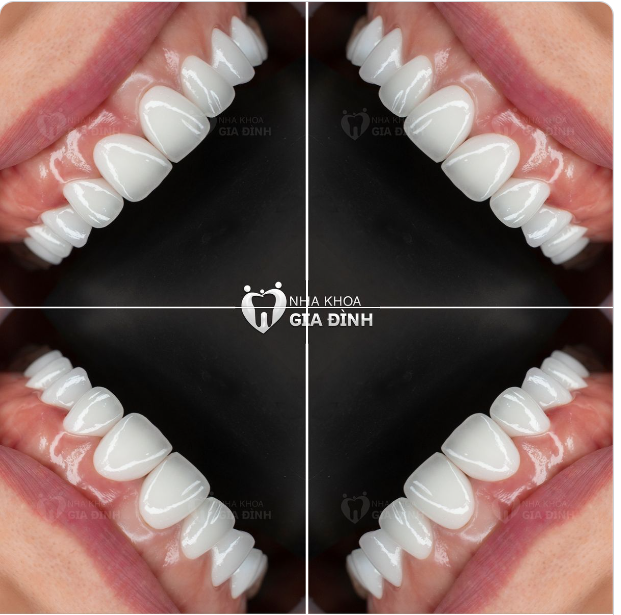RĂNG SỨ HOÀN HẢO CHO MỘT NỤ CƯỜI HOÀN MỸ