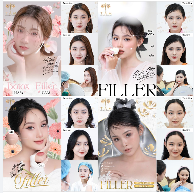 Thay đổi diện mạo NHANH CHÓNG - AN TOÀN với với FILLER - BOTOX tại Tấm