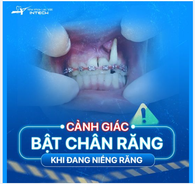 CẢNH BÁO BIẾN CHỨNG NGUY HIỂM: BẬT CHÂN RĂNG KHI NIỀNG RĂNG