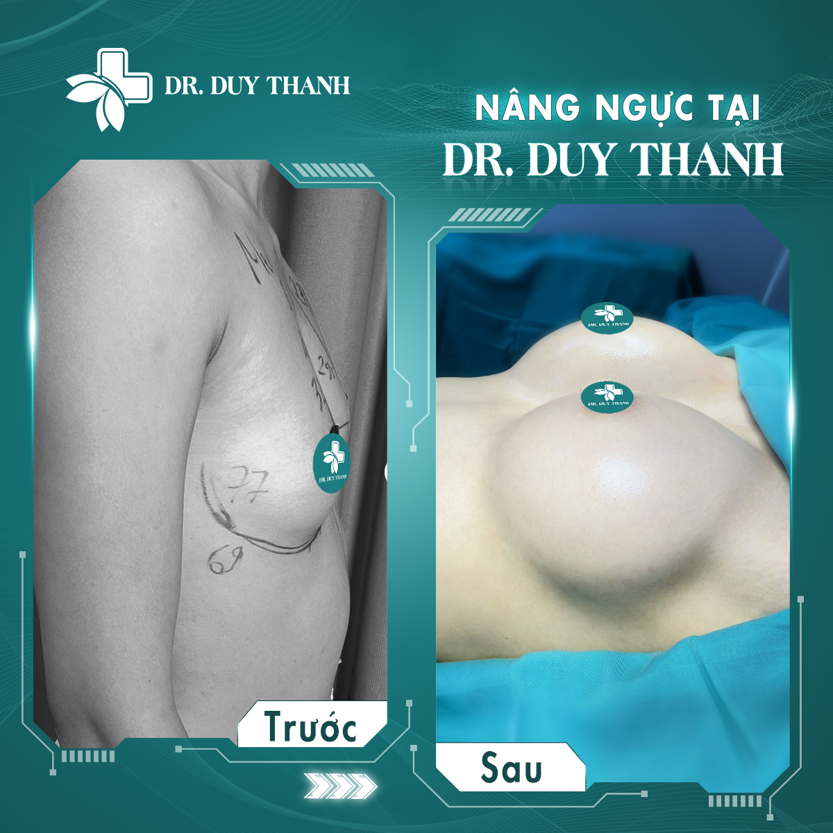 Nâng ngực cùng Dr Duy Thanh