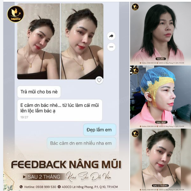 Feedback MŨI CAO SANG CHẢNH - TÀI LỘC HƯNG VƯỢNG SAU 2 THÁNG NÂNG MŨI CẤU TRÚC