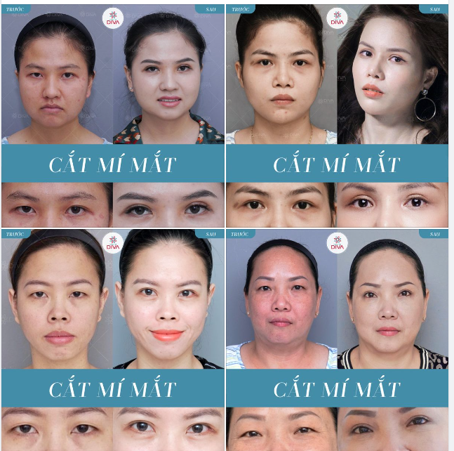 CẮT MÍ MẮT: MẮT ĐẸP, 2 MÍ ĐỀU SAU 7 NGÀY