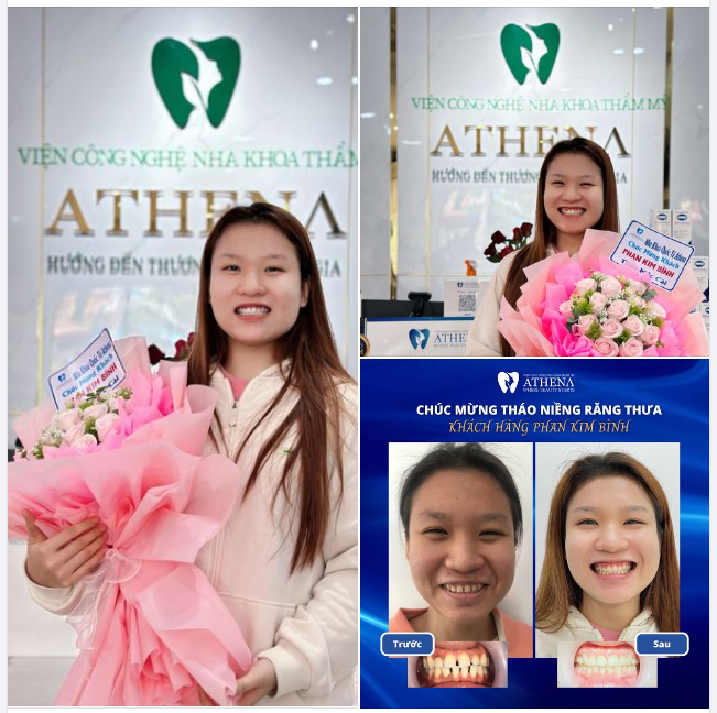 Niềng răng khép khe thưa tại nha khoa ATHENA và sự thăng hoa nhan sắc của khách hàng 