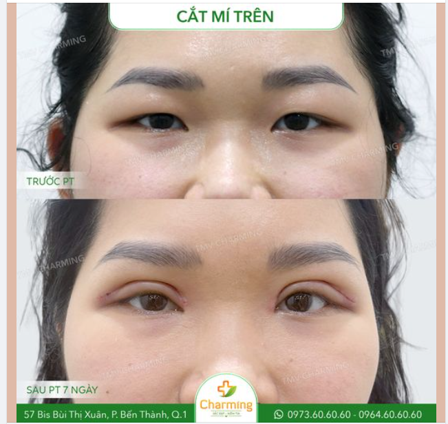 Nếu bạn đang tìm giải pháp cho đôi mắt có mí lót nhưng da chùng và mỡ thừa nhiều làm che mất đi nếp mí khiến mắt bạn trông như bị bụp vì khóc.
