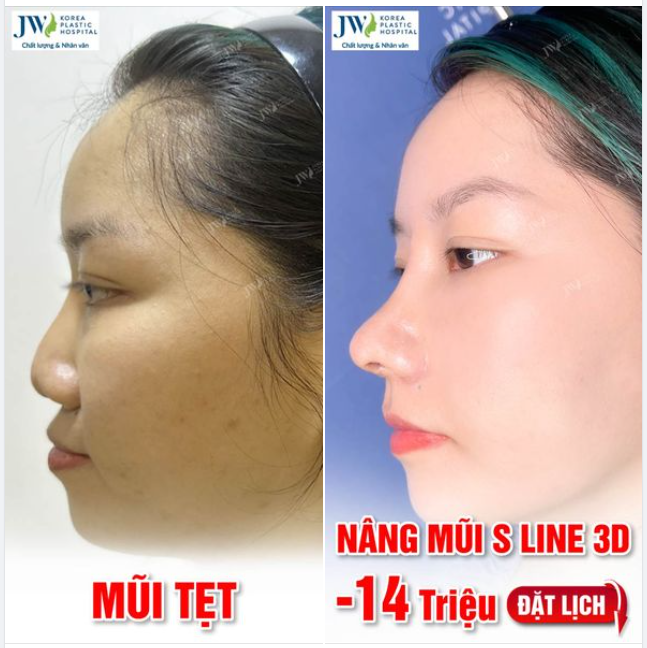 NÂNG MŨI S LINE 3D Chị gái sở hữu dáng mũi ĐẸP TỰ NHIÊN chuẩn châu Á