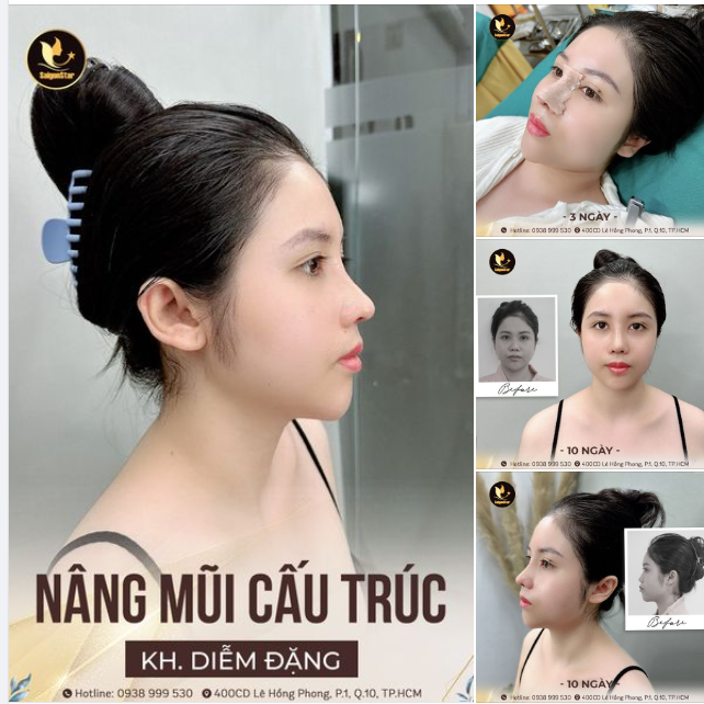 CÙNG NGẮM LẠI HÀNH TRÌNH TỪ CHIẾC MŨI THẤP TẸT - HÓA MŨI CAO SANG CHỈ TRONG 10 NGÀY CỦA KH. DIỄM ĐẶNG NHÉ!