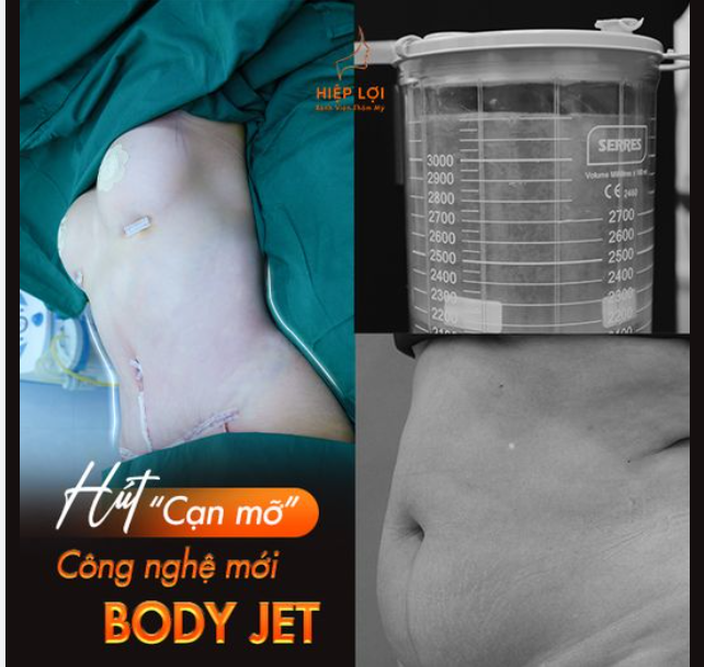 Bí quyết giảm cân nhanh với HÚT MỠ CÔNG NGHỆ CAO
