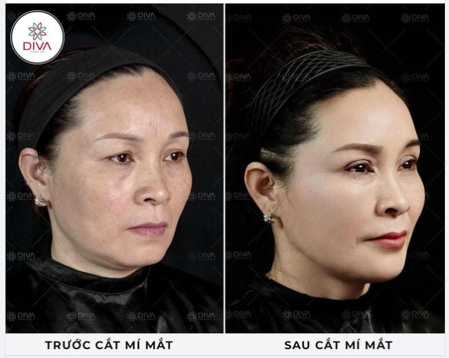 KẾT QUẢ THẨM MỸ: MẮT 2 MÍ ĐỀU ĐẸP SAU CẮT MÍ MẮT