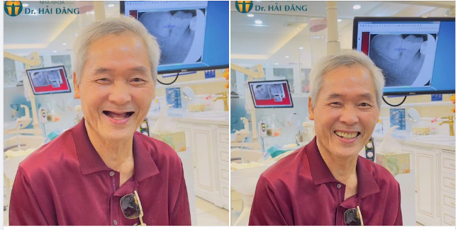 Hàm tháo lắp là phương pháp phục hình đơn giản với chi phí thấp, dễ dàng vệ sinh và dễ sử dụng.