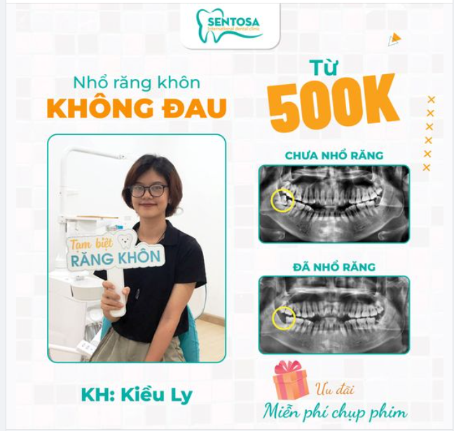 NHỔ RĂNG KHÔN KHÔNG ĐAU, SƯNG CHỈ TỪ 500K/RĂNG