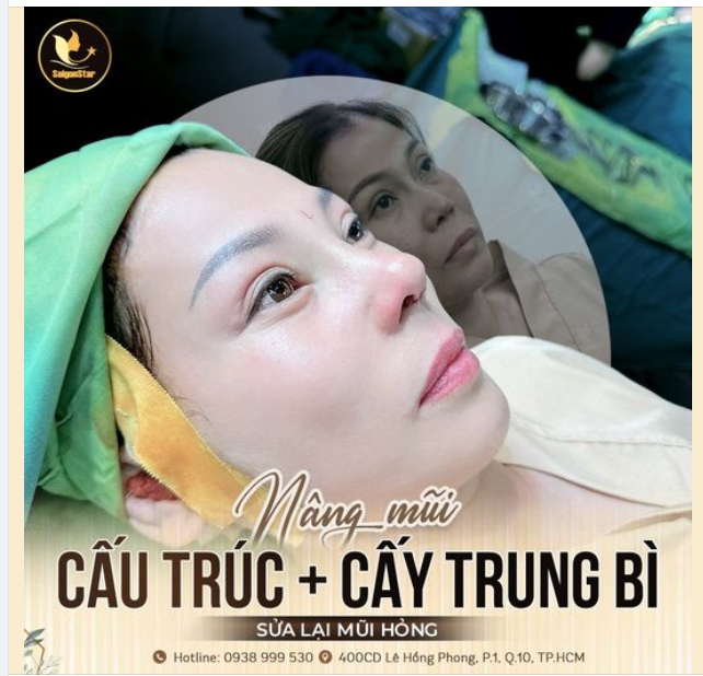 Chị Xuân Trang có thể xem là một trong hơn 10.000 case được Bác sĩ Hoạt thành công sửa lại mũi hỏng.