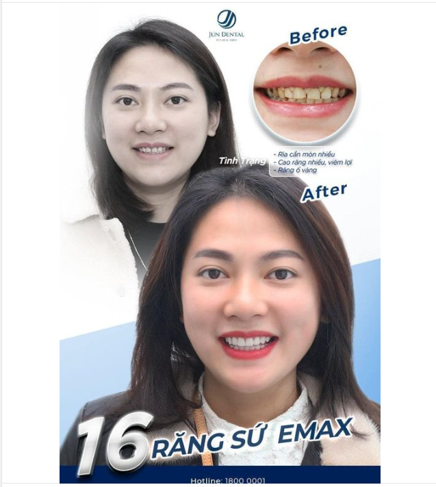 HỒI SINH NỤ CƯỜI MANG NHIỀU KHUYẾT ĐIỂM KHI ĐẾN VỚI JUN DENTAL