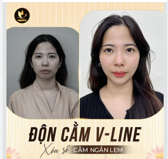 ĐỘN CẰM V-LINE – ĐIỂM TÔ NHAN SẮC, ĐẸP CHUẨN NÉT VÀNG