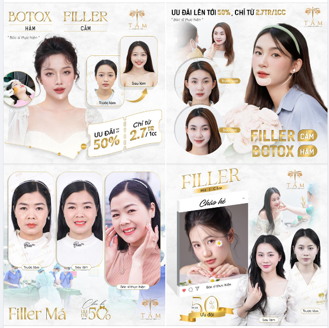 Ngắm qua hình ảnh khách hàng sau kh sử dụng combo filler cằm và botox thon gọn hàm tại Tấm nhé!