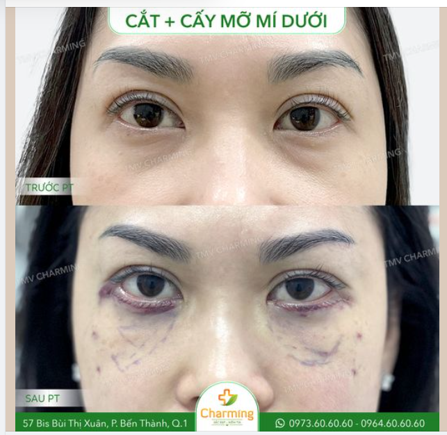 Nàng khách của Charming gặp phải vấn đề da chùng vùng mí dưới nhiều nhưng hốc mắt lại hơi sâu, khiến phần da chùng trông càng nghiêm trọng hơn.