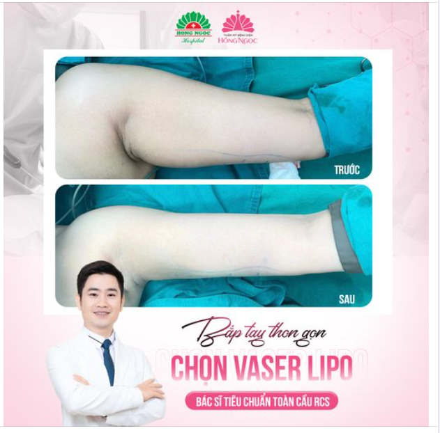 ƯNG NGAY BẮP TAY THON NHỎ SAU HÚ.T MỠ VASER LIPO