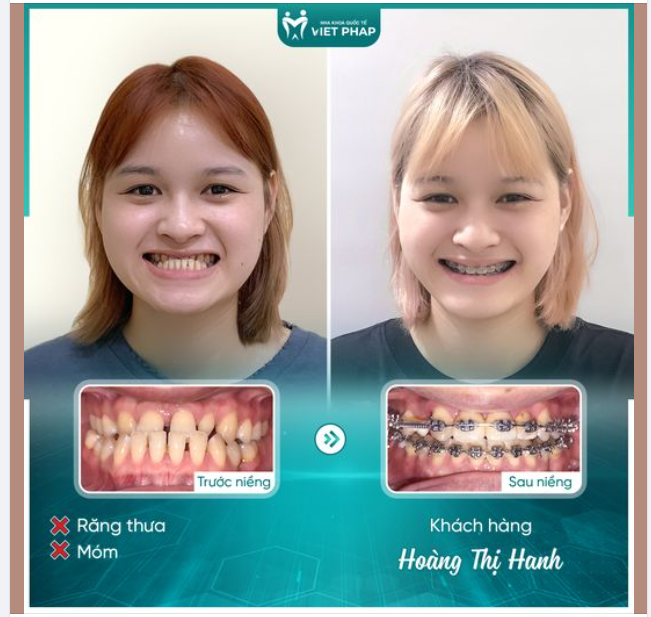 TẠM BIỆT HÀM RĂNG HÔ MÓM, CHÀO ĐÓN NỤ CƯỜI TỰ TIN