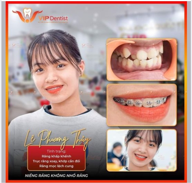 "EM RẤT BẤT NGỜ VỚI PHƯƠNG PHÁP NIỀNG KHÔNG NHỔ RĂNG CỦA NHA KHOA VIP DENTIST"