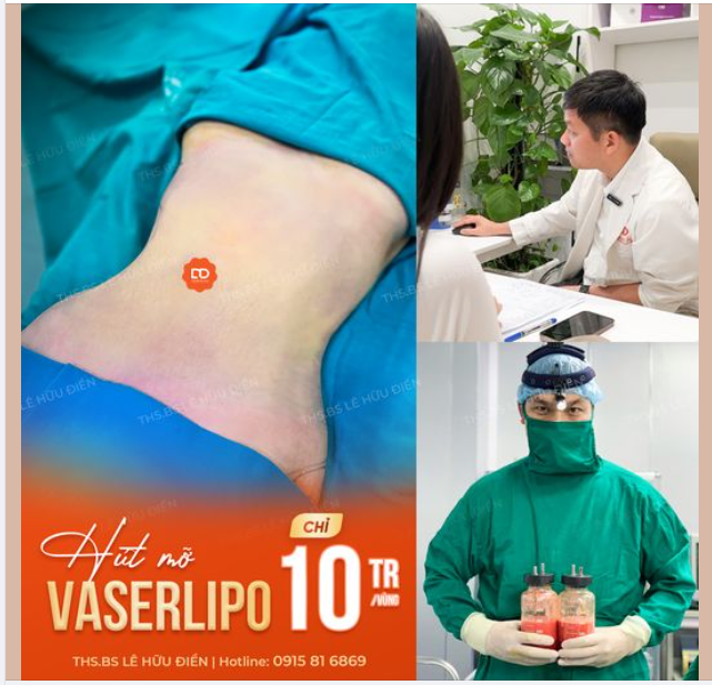 Về dáng tức thì chỉ sau 60 phút với công nghệ Hút mỡ Vaserlipo.