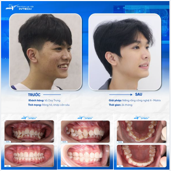 THÁO NIỀNG XONG LÊN ĐƯỜNG ĐI DU HỌC - NIỀNG RĂNG THỰC SỰ ĐÃ THAY ĐỔI CUỘC ĐỜI!