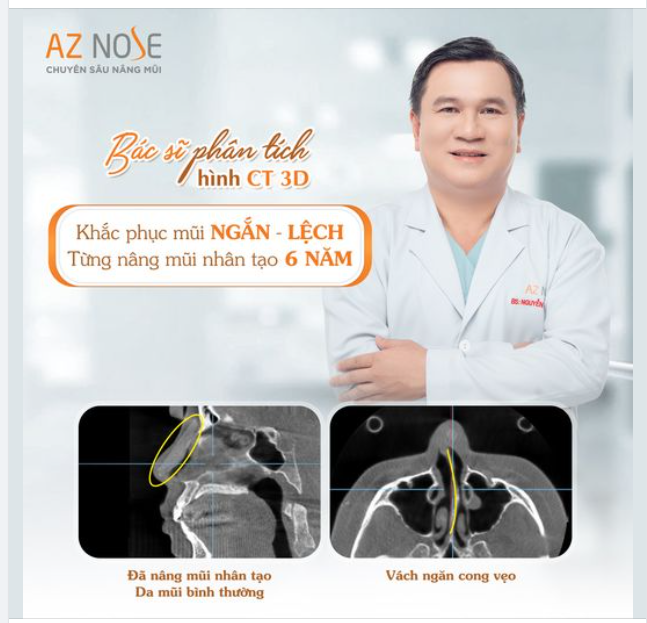 Khắc phục mũi ngắn - l.ệch cho khách hàng 8X