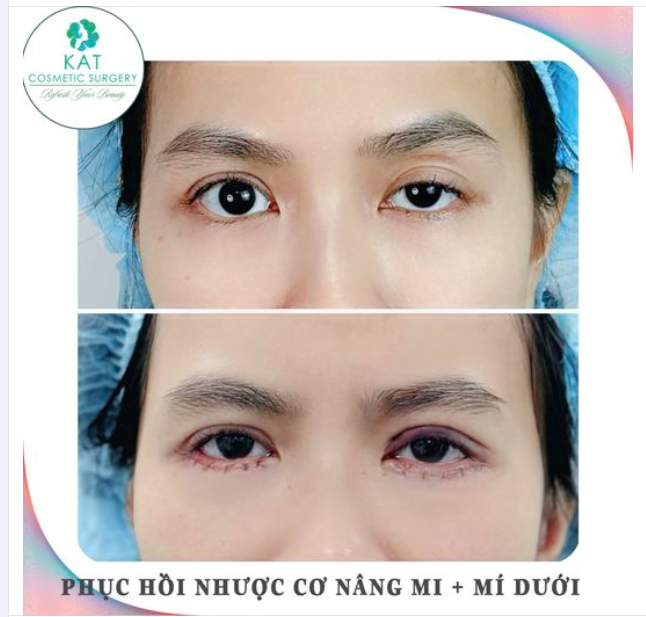 Chị khách đến với tình trạng nhược cơ nâng mi mắt trái và mắt dưới dư da , khi cười co nhiều nếp nhăn.