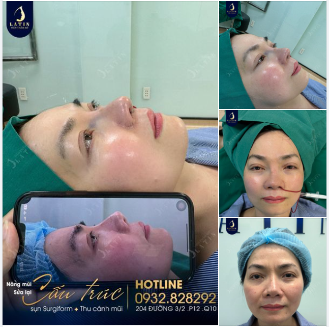 Sửa mũi có khó như bạn nghĩ. Mũi cấu trúc sửa lại cho chị khách Việt kiều Úc