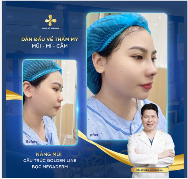 Minh chứng cho câu nói sau nâng mũi nhan sắc sẽ lên một tầm cao mới