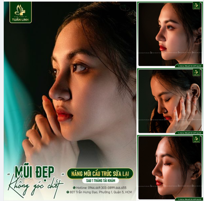 DÁNG MŨI SAU 1 THÁNG TÁI KHÁM - XỨNG ĐÁNG 10 ĐIỂM KHÔNG CÓ NHƯNG!!