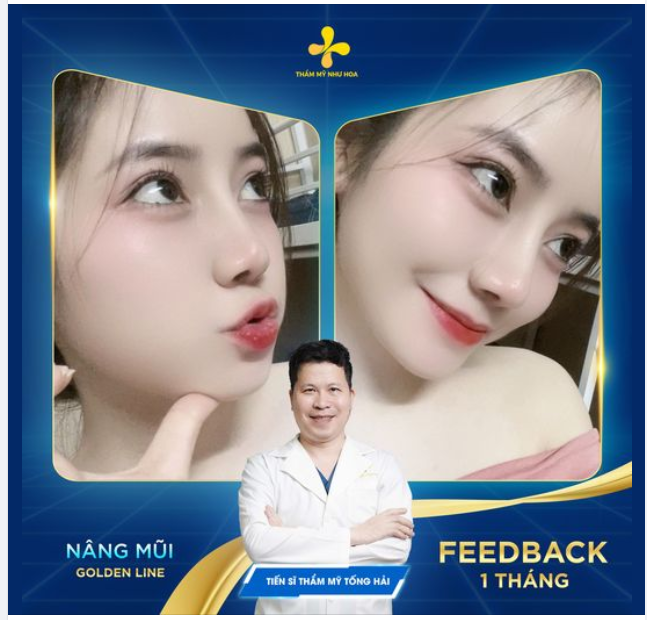 Feedback cực xinh sau 1 tháng nâng mũi Golden Line của nữ điều dưỡng sinh năm 2001.