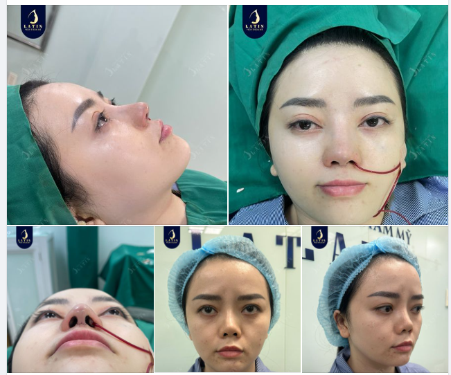 Mũi cấu trúc dáng tự nhiên cho em gái đến từ Kiên Giang