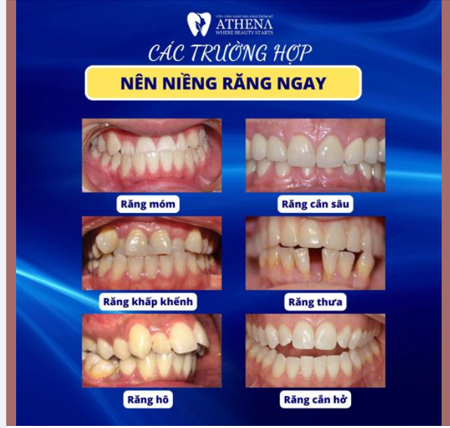 Niềng răng là phương pháp hiệu quả giúp khắc phục những sai lệch của hàm răng, từ đó cải thiện chức năng ăn nhai và lấy lại sự tự tin trong giao tiếp.