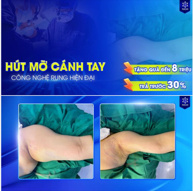 Bắp tay thon gọn - Tự tin diện mọi bộ cánh