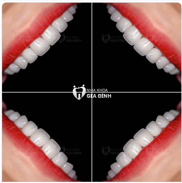 BẠN CÓ MUỐN SỞ HỮU CHO MÌNH 1 HÀM RĂNG ĐẸP NHƯ THẾ NÀY?