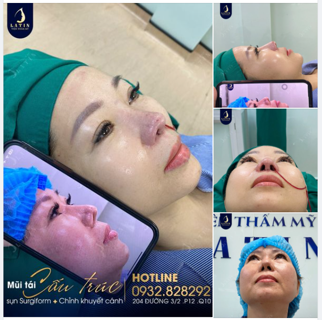 Hoàn thành ca mũi sửa lại cho chị gái đến từ Cà Mau
