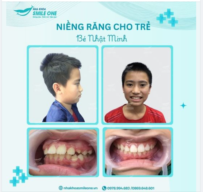 NIỀNG RĂNG CHO TRẺ - BỐ MẸ NÊN BIẾT ĐỂ GIÚP TRẺ PHÁT TRIỂN TOÀN DIỆN